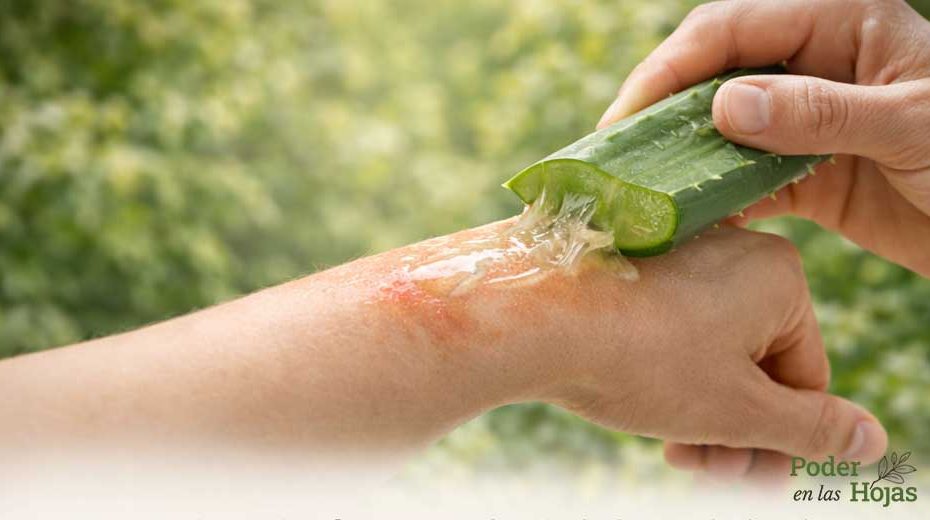 aloe vera para quemaduras 01
