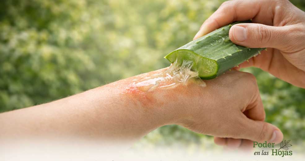 aloe vera para quemaduras 01
